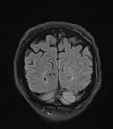File:Cerebral arteriovenous malformation (Radiopaedia 84015-99245 Coronal FLAIR 28).jpg