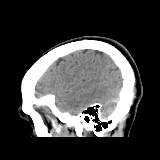 Cerebral arteriovenous malformation (Spetzler-Martin grade 2) (Radiopaedia 41262-44076 A 50).png