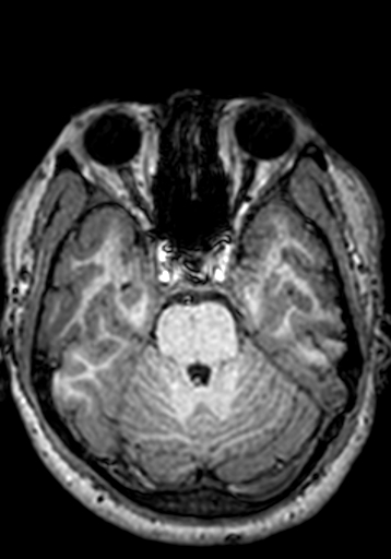 Cerebral arteriovenous malformation at posterior body of corpus callosum (Radiopaedia 74111-84925 Axial T1 215).jpg