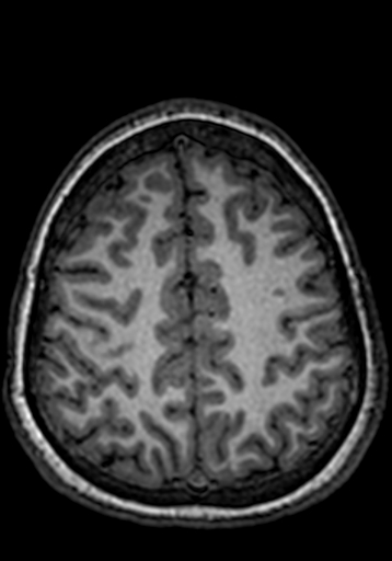 Cerebral arteriovenous malformation at posterior body of corpus callosum (Radiopaedia 74111-84925 Axial T1 61).jpg