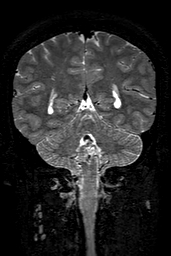 Cerebral arteriovenous malformation at posterior body of corpus callosum (Radiopaedia 74111-84925 Coronal T2 124).jpg