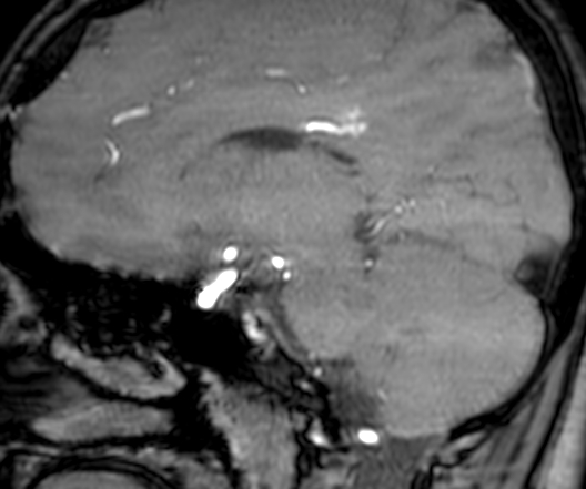 Cerebral arteriovenous malformation at posterior body of corpus callosum (Radiopaedia 74111-84925 J 168).jpg