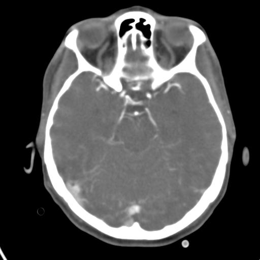 Cerebral arteriovenous malformation with hemorrhage (Radiopaedia 28773-29073 A 35).jpg