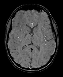 Cerebral cavernous venous malformation (Radiopaedia 70008-80021 I 40).jpg