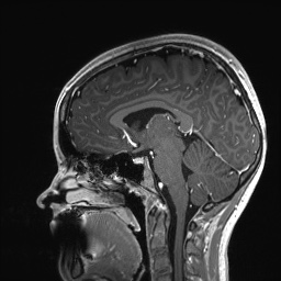 Cerebral cavernous venous malformation (Radiopaedia 70008-80021 Sagittal T1 C+ 34).jpg