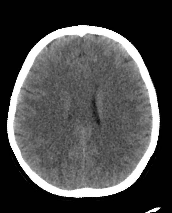 Cerebral edema due to severe hyponatremia (Radiopaedia 89826-106938 Axial non-contrast 65).jpg