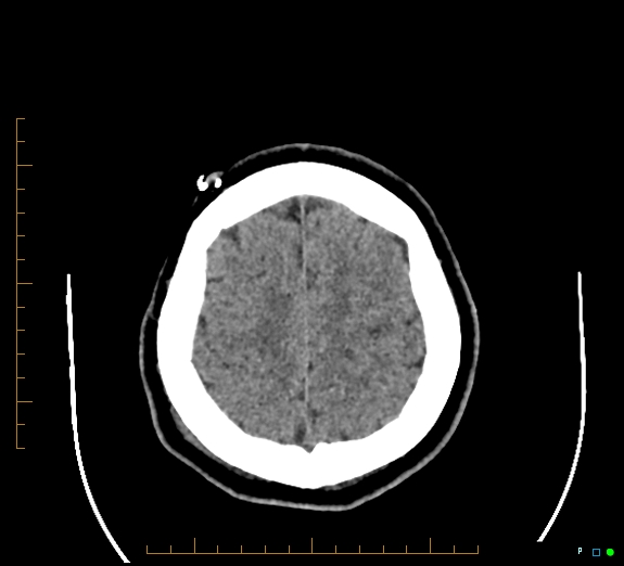 File:Cerebral fat embolism (Radiopaedia 85521-101220 Axial non-contrast 50).jpg