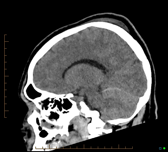 Cerebral fat embolism (Radiopaedia 85521-101224 C 22).jpg