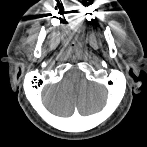 Cerebral hemorrhagic contusions and cervical spine fractures (Radiopaedia 32865-33841 F 7).jpg