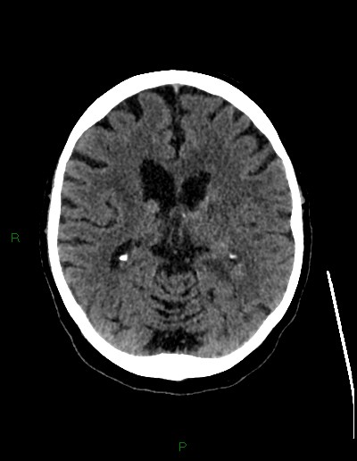 Cerebral metastases - ependymal and parenchymal (Radiopaedia 79877-93131 Axial non-contrast 40).jpg