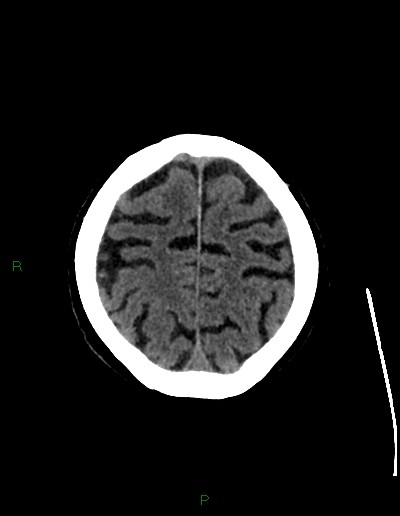 Cerebral metastases - ependymal and parenchymal (Radiopaedia 79877-93131 Axial non-contrast 66).jpg