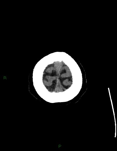 Cerebral metastases - ependymal and parenchymal (Radiopaedia 79877-93131 Axial non-contrast 78).jpg