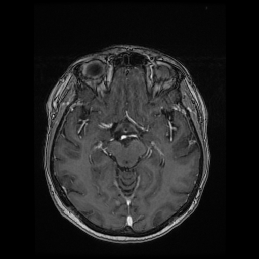 File:Cerebral metastases - melanoma (Radiopaedia 80972-94522 Axial T1 C+ 49).jpg