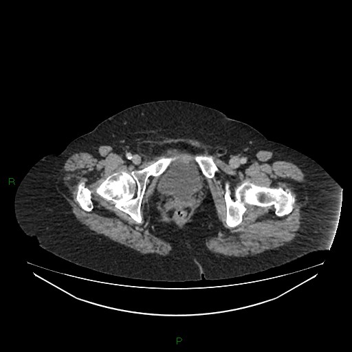 File:Cerebral metastasis from renal cell carcinoma (Radiopaedia 82306-96378 A 189).jpg