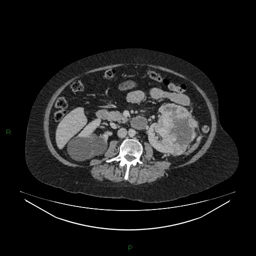 Cerebral metastasis from renal cell carcinoma (Radiopaedia 82306-96378 A 86).jpg