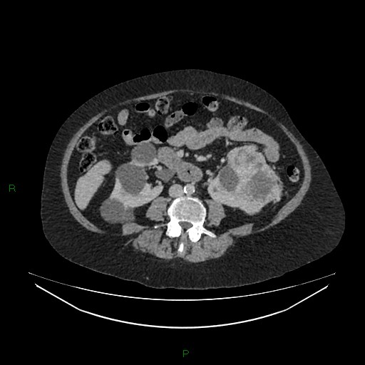 File:Cerebral metastasis from renal cell carcinoma (Radiopaedia 82306-96378 A 98).jpg
