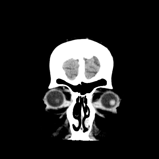Cerebral metastasis to basal ganglia (Radiopaedia 81568-95412 Coronal C+ delayed 8).png