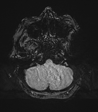 Cerebral metastasis to basal ganglia (Radiopaedia 81568-95413 Axial SWI 12).png