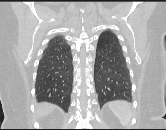 Cerebral metastasis to basal ganglia (Radiopaedia 81568-95414 Coronal lung window 68).png