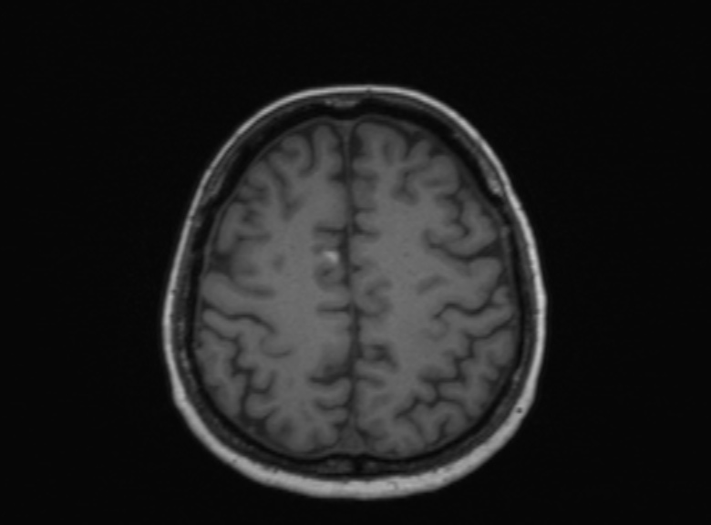 Cerebral ring enhancing lesions - cerebral metastases (Radiopaedia 44922-48817 Axial T1 157).jpg