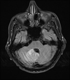 File:Cerebral toxoplasmosis (Radiopaedia 43956-47461 Axial FLAIR 6).jpg