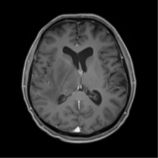 Cerebral toxoplasmosis (Radiopaedia 54575-60804 Axial T1 C+ 31).png