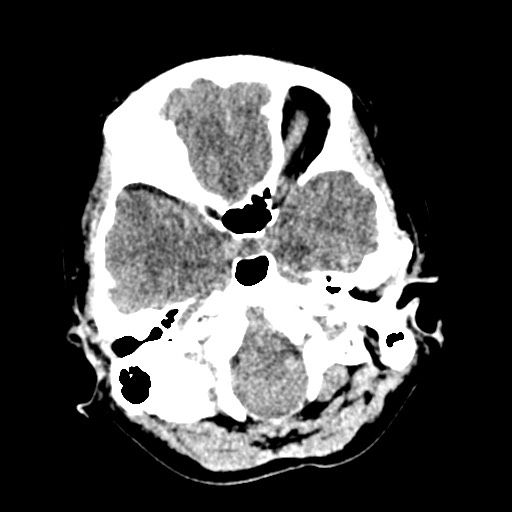 Cerebral tuberculosis with dural sinus invasion (Radiopaedia 60353-68018 Axial non-contrast 9).jpg