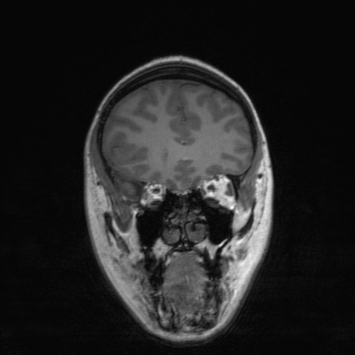 Cerebral tuberculosis with dural sinus invasion (Radiopaedia 60353-68090 Coronal T1 55).jpg