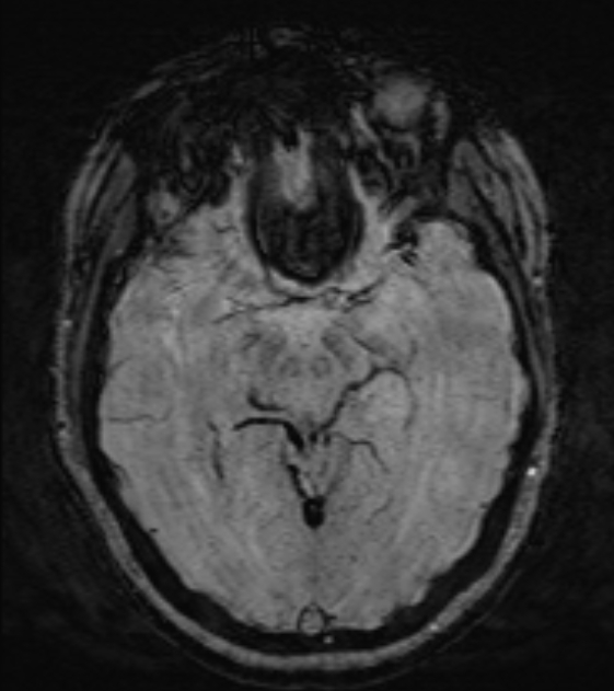 Cerebral venous infarct (Radiopaedia 53627-59685 Axial SWI 23).jpg