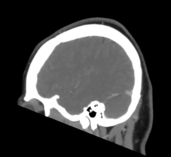 File:Cerebral venous infarction due to transverse sinus thrombosis (Radiopaedia 34688-36120 Sagittal CT venogram 41).png