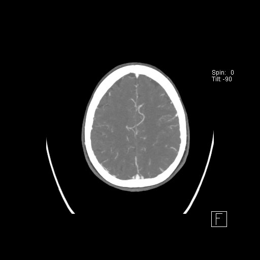 Cerebral venous infarction with hemorrhage (Radiopaedia 65343-74396 A 101).jpg