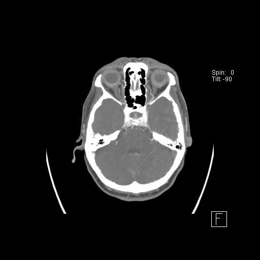 Cerebral venous infarction with hemorrhage (Radiopaedia 65343-74396 A 30).jpg