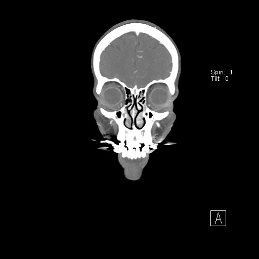 Cerebral venous infarction with hemorrhage (Radiopaedia 65343-74396 B 41).jpg