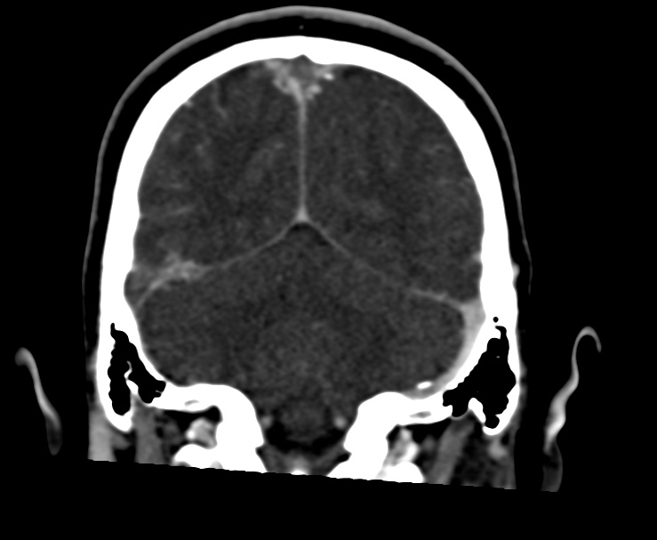 Cerebral venous sinus thrombosis (Radiopaedia 59224-66646 Coronal C+ delayed 59).jpg