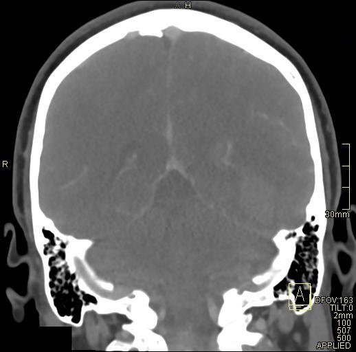 Cerebral venous sinus thrombosis (Radiopaedia 91329-108965 Coronal venogram 59).jpg