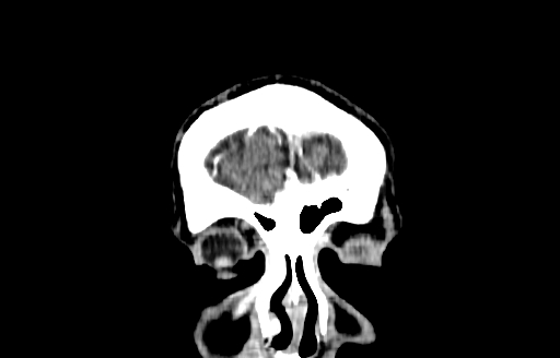 File:Cerebral venous thrombosis (CVT) (Radiopaedia 77524-89685 C 1).jpg