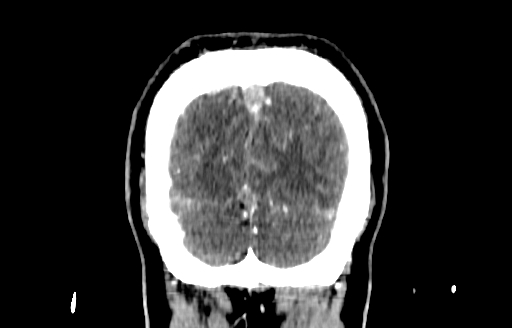 File:Cerebral venous thrombosis (CVT) (Radiopaedia 77524-89685 C 59).jpg