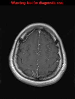 File:Cerebral venous thrombosis (Radiopaedia 37224-39208 Axial T1 C+ 18).jpg