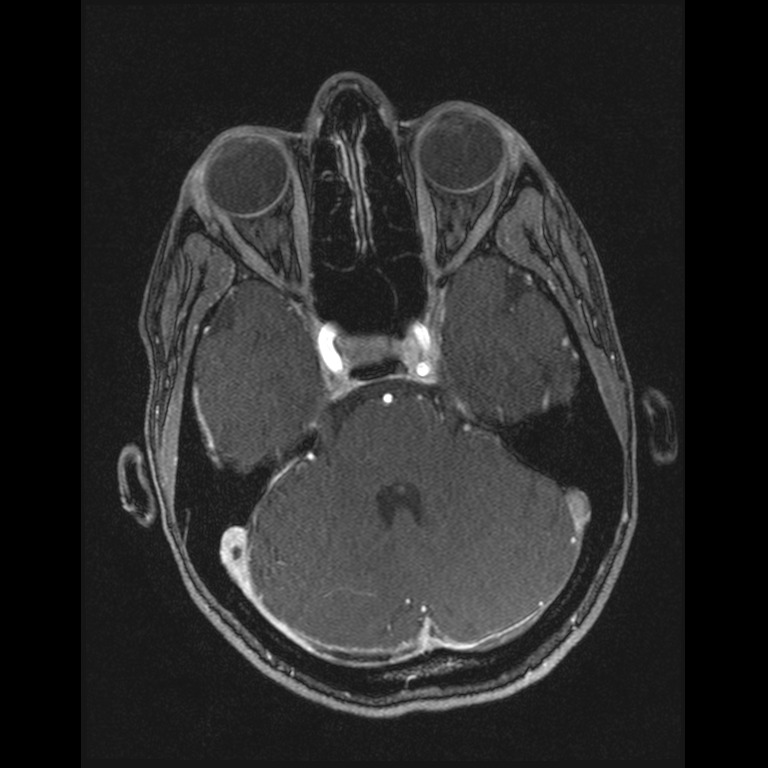 Cerebral venous thrombosis (Radiopaedia 45678-49854 Axial MRV 19).jpg
