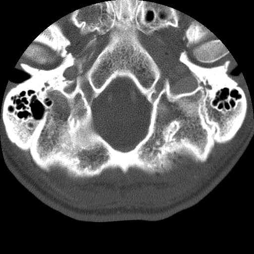 Cervical Pott disease (Radiopaedia 20374-20286 Axial bone window 6).jpg