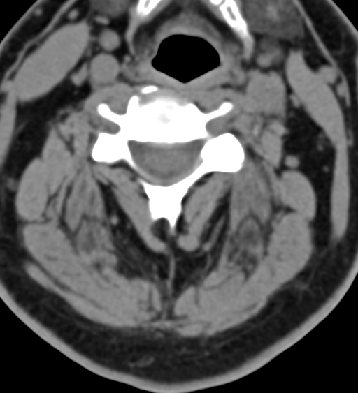 Cervical canal stenosis due to ossification of the posterior longitudinal ligament (Radiopaedia 47260-51823 Axial non-contrast 28).png