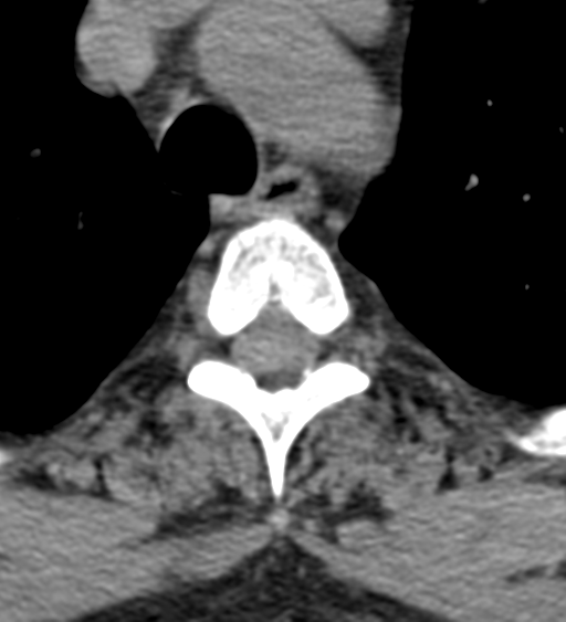 File:Cervical canal stenosis due to ossification of the posterior longitudinal ligament (Radiopaedia 47260-51823 Axial non-contrast 69).png