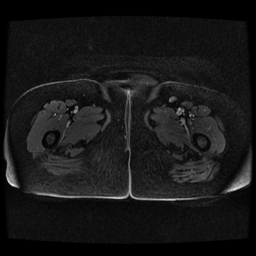 Cervical carcinoma (Radiopaedia 70924-81132 Axial T1 C+ fat sat 185).jpg
