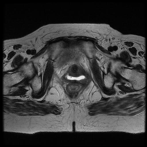 File:Cervical carcinoma (Radiopaedia 70924-81132 Axial T2 15).jpg