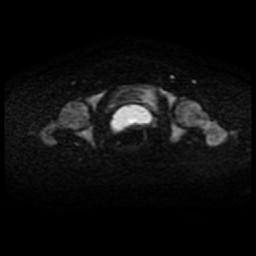 Cervical carcinoma (Radiopaedia 88010-104555 Axial DWI 46).jpg