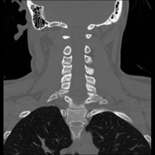 File:Cervical rib (Radiopaedia 71110-81363 Coronal non-contrast 22).jpg