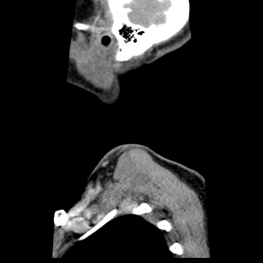 Cervical schwannoma (Radiopaedia 57979-64974 H 57).png