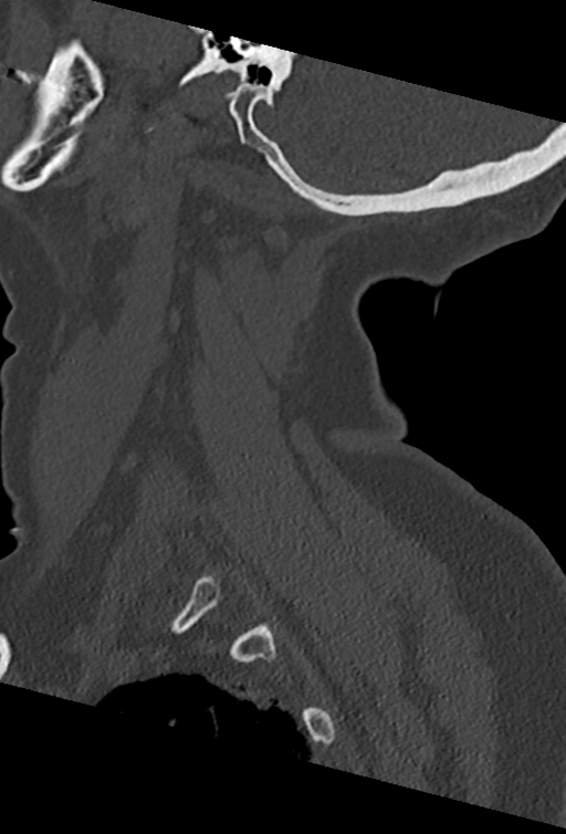 Cervical spine ACDF loosening (Radiopaedia 48998-54070 Sagittal bone window 19).png