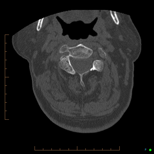 File:Cervical spine fracture - ankylosing spondylitis (Radiopaedia 76835-88706 Axial bone window 64).jpg