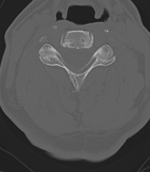 File:Cervical spine fractures with vertebral artery dissection (Radiopaedia 53296-59268 Axial bone window 29).png